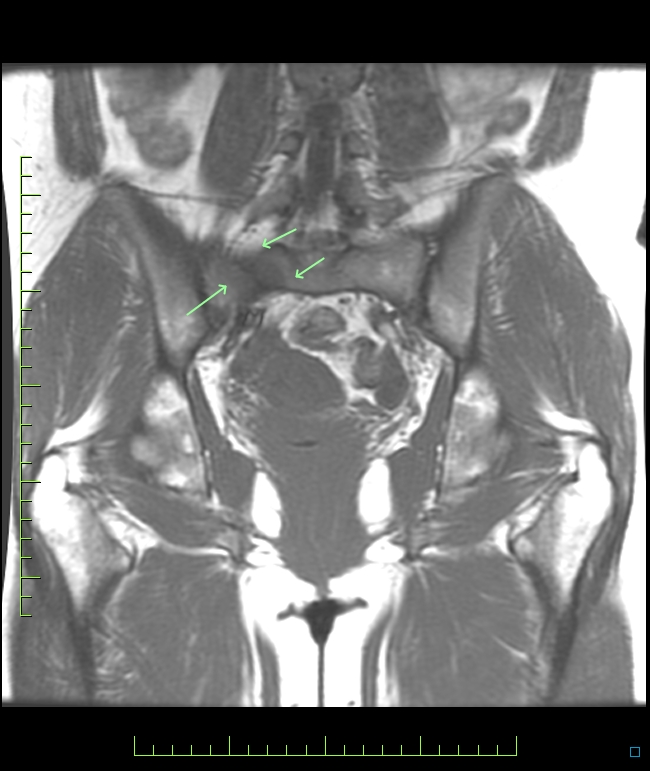 Figure 3 for case R sacral stress fx